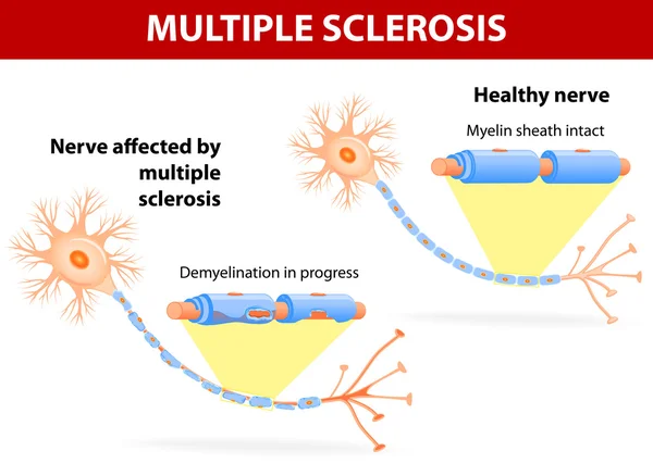 Nervio afectado por la esclerosis múltiple — Archivo Imágenes Vectoriales