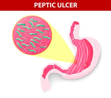 Peptic ulcer clipart
