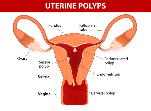 endometrium polip veya uterus polip