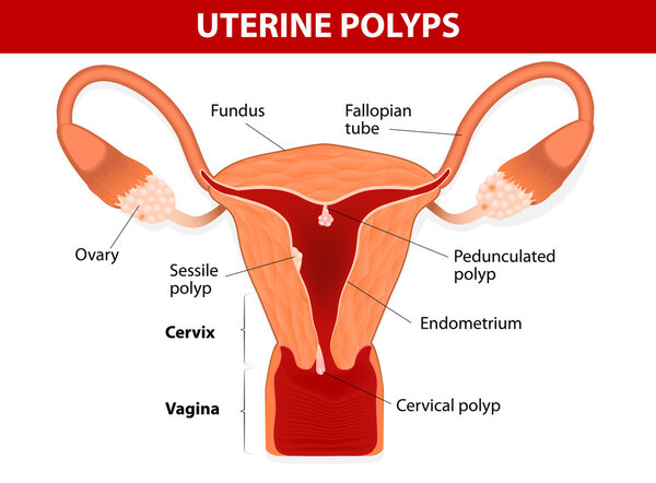 Endometrial polyp or uterine polyp
