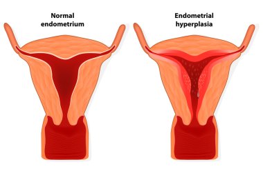 Endometrial hyperplasia clipart