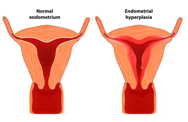 Endometrium hiperplázia — Stock Vector