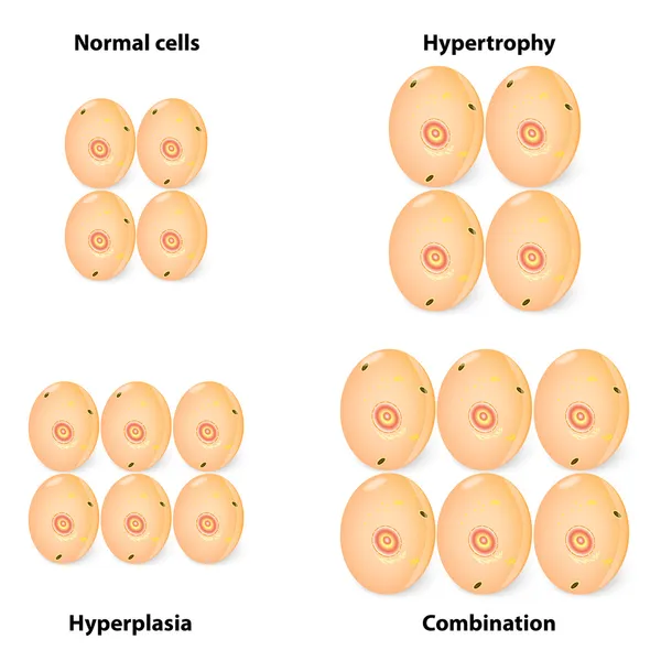 Hiperplasia de diferencia, hipertrofia y células normales — Vector de stock
