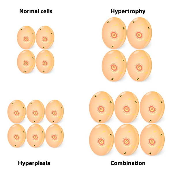 Διαφορά υπερπλασία και υπερτροφία και φυσιολογικά κύτταρα — Διανυσματικό Αρχείο