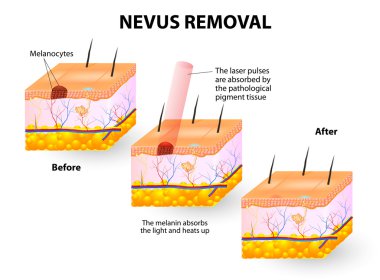 Nevus kaldırma