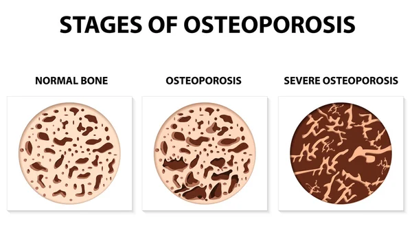 Etapas de la Osteoporosis — Vector de stock