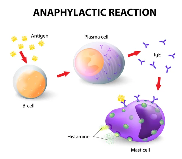 Аллергия и анафилаксия — стоковый вектор