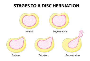 disk herniasyonu için aşamaları
