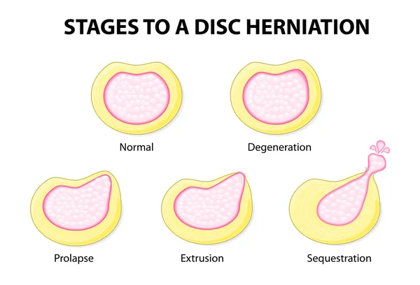 Disk herniasyonu için aşamaları — Stok Vektör