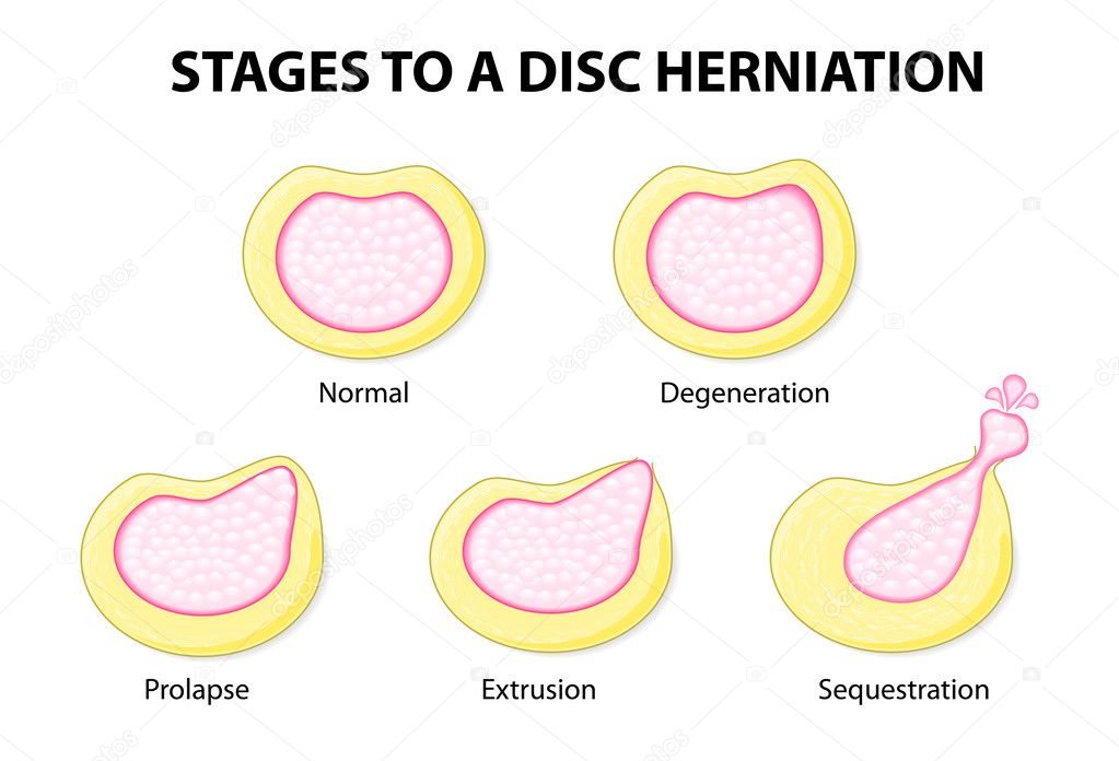 Stages to a disc herniation