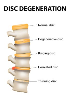 disk dejenerasyonu