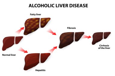 alkolik karaciğer hastalığı