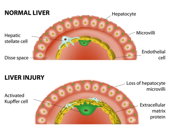 Lesiones hepáticas y hepáticas normales . — Vector de stock