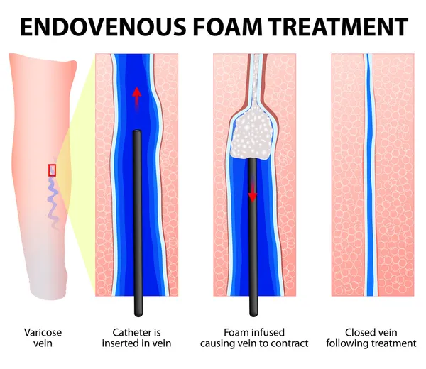 Escleroterapia de espuma. Escleroespumas — Vetor de Stock