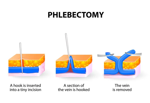 Phlebectomy ambuláns kezelés — Stock Vector