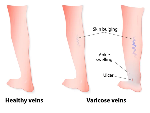 Veias varicosas — Vetor de Stock