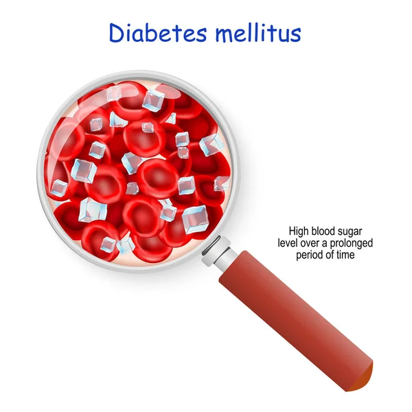 糖尿病Didiabetes Itus 长时间内血糖水平很高 放大镜 血流量与红细胞和葡萄糖 糖立方体 的密切关系 — 图库矢量图片