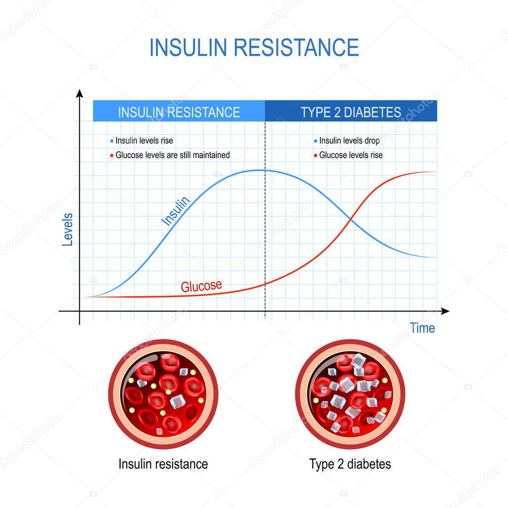 Insulin resistance and Type 2 diabetes. comparison and difference. high blood sugar. Chart with insulin and glucose levels. Cross section of blood vessel. Vector diagram