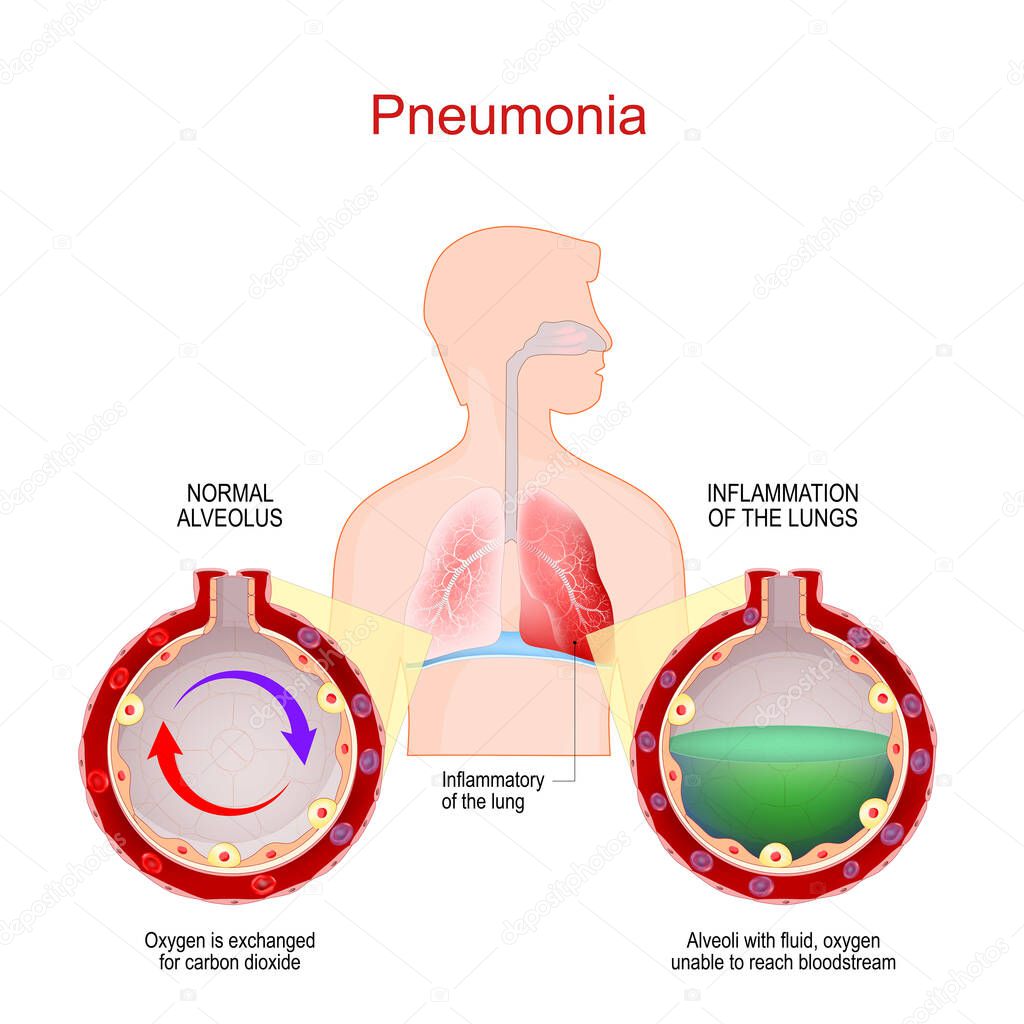 Pneumonia. Lung infection. Inflammatory of the respiratory system. Close-up of healthy alveolus and Alveoli with fluid, where oxygen unable to reach bloodstream. comparison and difference. Vector poster for medical use