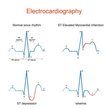 Elektrokardiyografi. Kalp ekokardiyogramı veya kalp kardiyogramı normal sinüs ritmi, ST Yüksek Myokardiyal Enfarktüsü, Ishemia, ST depresyonu. Farklılık ve karşılaştırma. Eğitim için vektör diyagramı