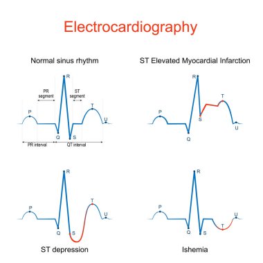 Electrocardiography. ECG or EKG of a heart with normal sinus rhythm, ST Elevated Myocardial Infarction, Ishemia, ST depression. difference and comparison. Vector diagram for education clipart