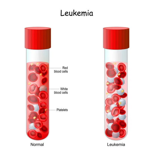 白血病 与正常血癌和血癌的对比和差异测试管 红血球和淋巴细胞的特写 矢量说明 — 图库矢量图片