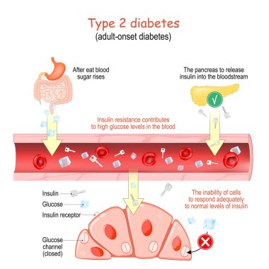 Type 2 diabetes. adult-onset diabetes. Insulin resistance contributes to high glucose levels in the blood. The inability of cells to respond adequately to normal levels of insulin. Vector poster for educational and medical use clipart
