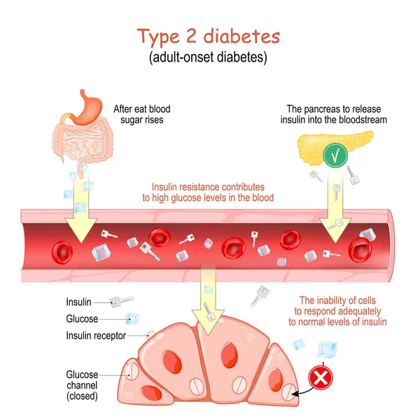 Diabete Tipo Diabete Esordio Adulto Resistenza All Insulina Contribuisce Livelli — Vettoriale Stock