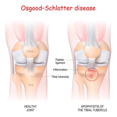 Osgood-Schlatter hastalığı. Tibial tüberkülde sağlıklı eklem ve apofizit. Vektör çizimi. Tıbbi kullanım için poster