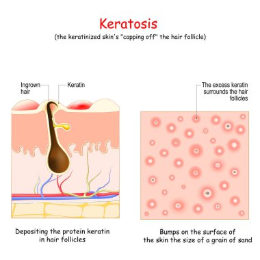 Keratosis. Skin disease. top view with Depositing the protein keratin in hair follicles. and cross section of human skin with Bumps on the surface of the skin the size of a grain of sand. hornlike skin condition. Vector illustration. Poster for medic clipart