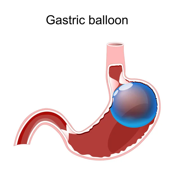 ガス気球だ 胃の中に悲劇的なバルーン 体重減少 外科手術を受けました 医療用ベクトル図 — ストックベクタ