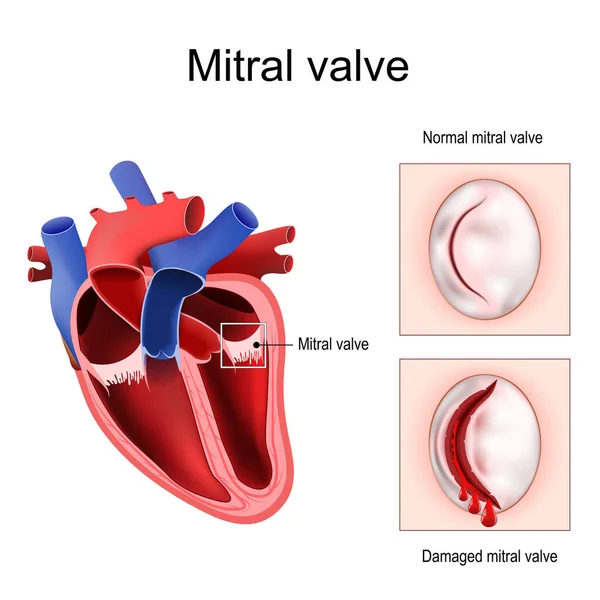 心脏解剖 正常二尖瓣和受损二尖瓣的特写 人的心脏横断面详细图表 病媒宣传画 — 图库矢量图片