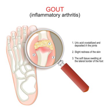 Gout. Close-up of joint with inflammatory arthritis. Humans foot with crystallization of uric acid and magnifying glass. Vector illustration. poster explains Signs and symptoms of disease clipart
