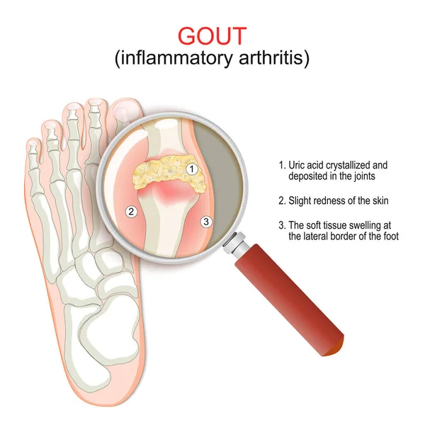 Gout Close Joint Inflammatory Arthritis Humans Foot Crystallization Uric Acid — Stock Vector