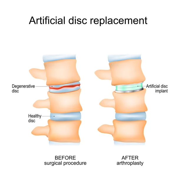 Artroplastia Disco Intervertebral Primer Plano Una Columna Vertebral Humana Antes — Vector de stock