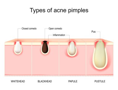 Sivilce tipleri. Sivilceli insan derisinin çapraz kesimi. Whitehead, Blackhead, Papule ve Pustule. vektör diyagramı.