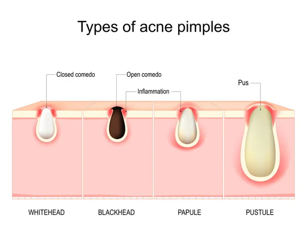 Soorten Acne Puistjes Doorsnede Van Menselijke Huid Met Acne Vulgaris — Stockvector