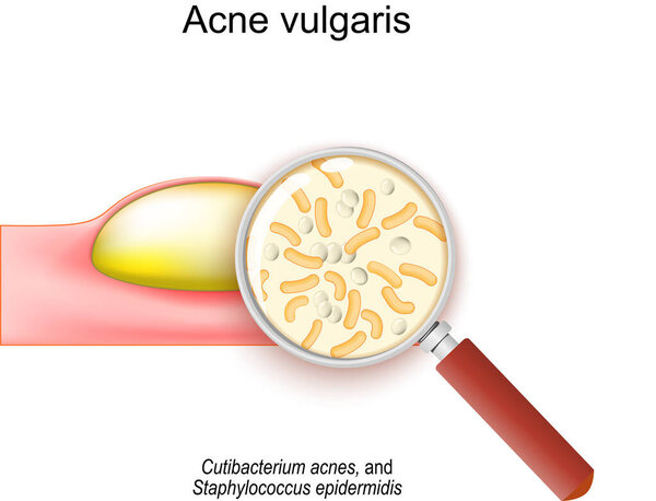 Close-up of Acne vulgaris. Cross-section of a human skin with pimple. Magnifying glass and bacteria that cause of acne. Cutibacterium acnes, and Staphylococcus epidermidis. Vector illustration