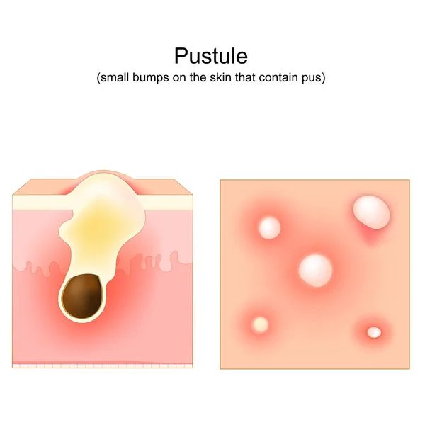 Acne Pustule Small Bump Skin Contain Pus Cross Section Human — Stock vektor