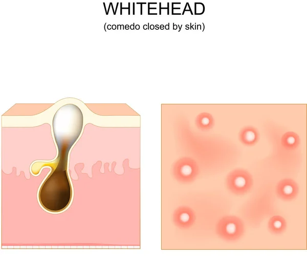 Acné Whitehead Poro Obstruido Comedo Corte Transversal Una Piel Humana — Vector de stock