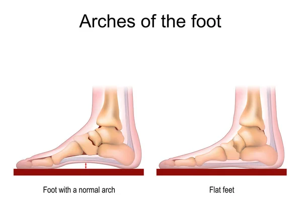 Arches Foot Foot Normal Arch Flat Feet Vector Poster Medical — стоковый вектор