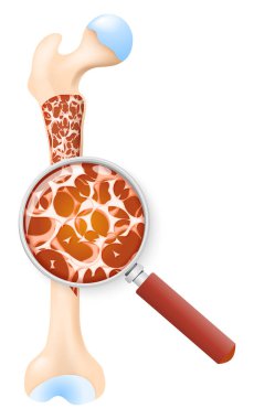 Kemik erimesi. Uyluk kemiğinin kesiti. Kemik kütlesi ve büyüteç yakın çekim. vektör illüstrasyonu