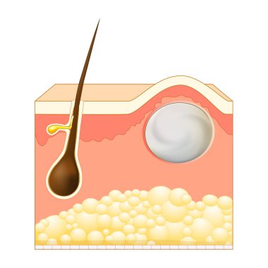 Wen, sebaceous cyst, a form of trichilemmal cyst. Epidermoid or Pilar cysts. Cross section of skin layers with hair follicle and steatocystoma. Vector illustration clipart