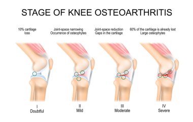 Diz eklem iltihabı. OA aşamaları. Kellgren ve Lawrence osteoartritin değerlendirme aşaması kriterleri. Sınıflandırmalar osteofil oluşumuna ve eklem boşluğunun daralmasına dayanıyor. Yan görünüş. Vektör