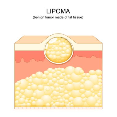 Lipoma. Derideki deri altı dokularında bulunan adipoz tümörleri. Vektör çizimi. Deri tabakaları