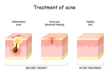 Treatment of acne. Skin layers Before and after therapy. Inflammatory acne, scar or abnormal healing and healthy skin. vector illustration