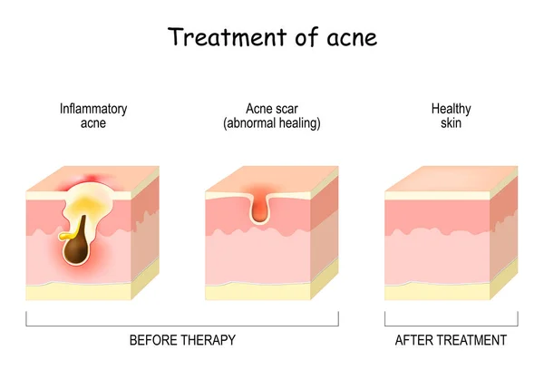 Treatment Acne Skin Layers Therapy Inflammatory Acne Scar Abnormal Healing —  Vetores de Stock
