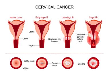 Cervical cancer or cervix carcinoma. development stage. vector illustration clipart