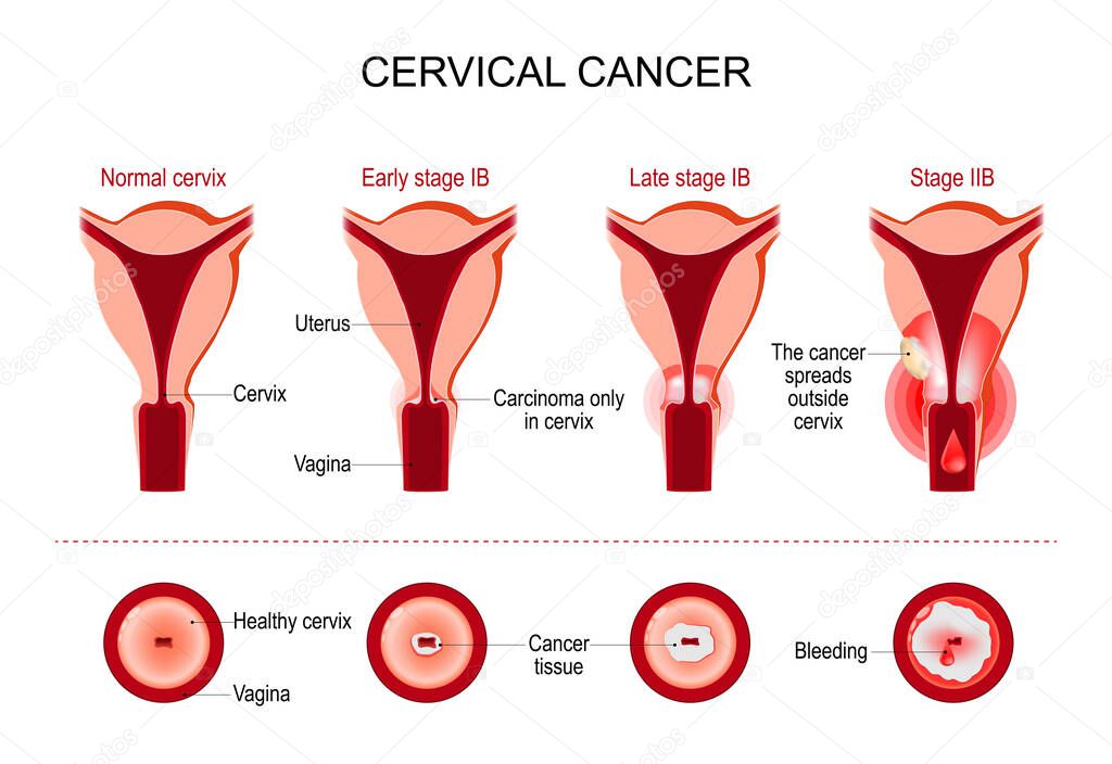 Cervical cancer or cervix carcinoma. development stage. vector illustration