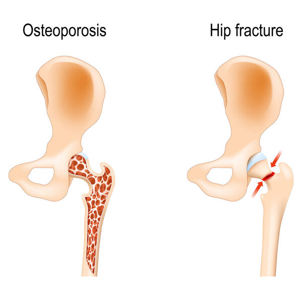 aging process in the human bones. Osteoporosis that caused of Hip fracture. vector illustration. medical poster